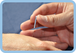 Inserting Acupuncture needles in Vancouver patient